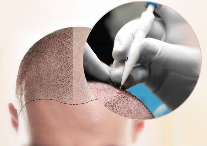 Hair Transplantation in Different Ethnicities - Tailored Approaches for Diverse Hair Types
