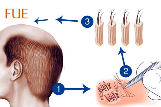 Hair Transplantation in Different Ethnicities - Tailored Approaches for Diverse Hair Types